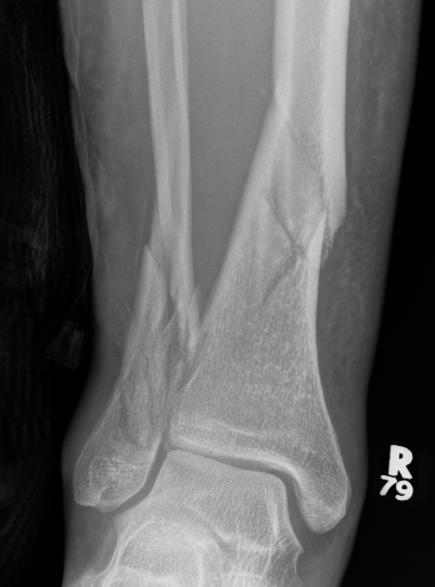 Distal tibia 